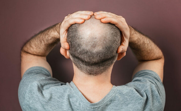 Bald Spot on Crown of Head | Causes, Symptoms, Hairstyles
