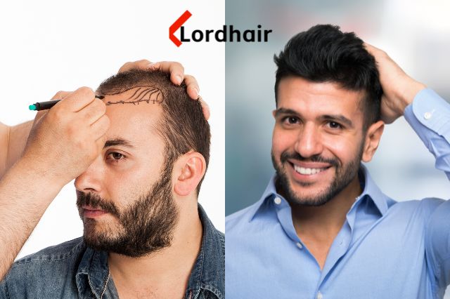 Hair system vs hair transplant
