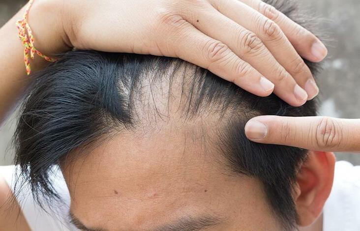 medical conditions that cause hair loss