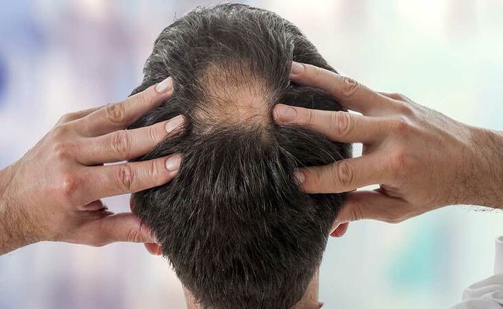 what doctor to see for hair loss
