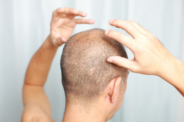 prevent dry scalp hair loss
