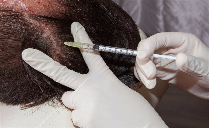 scalp psoriasis and hair loss