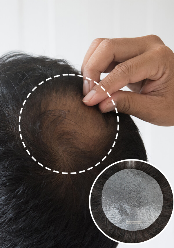 crown patch for hair loss