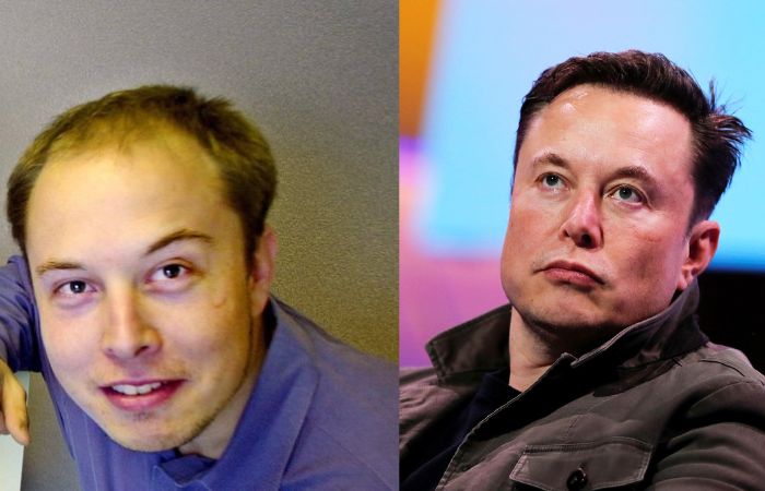 Elon musk hair loss story