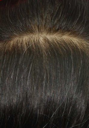 f002 hair replacement system