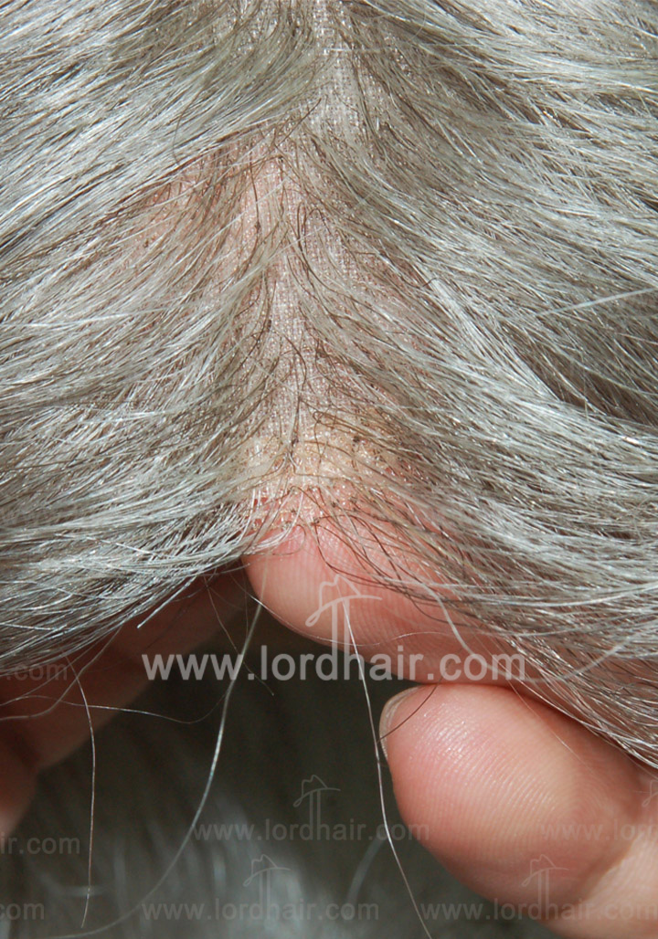 jq234 hair replacement system