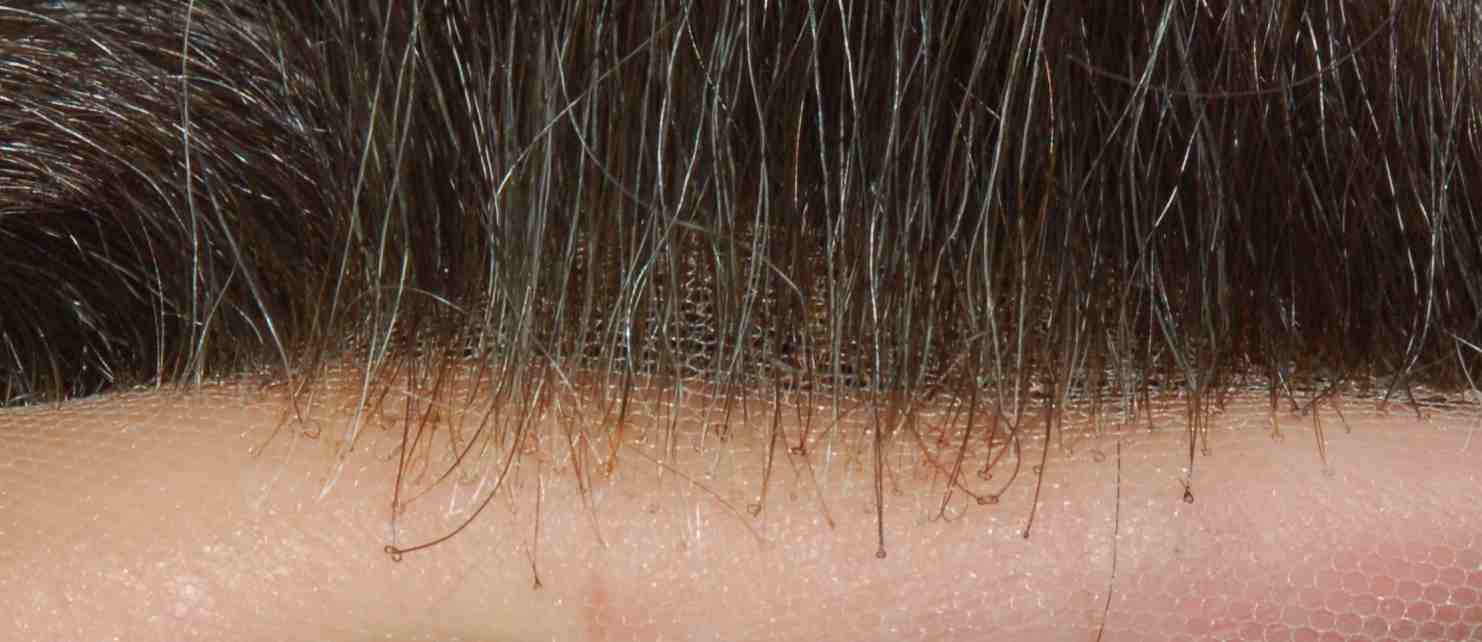 Hairline of Lace Hair System