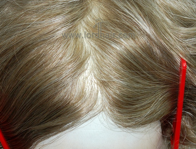 transparnet skin injected hair replacement