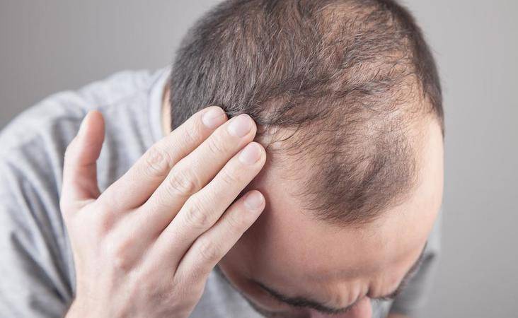 men hair thinning disease