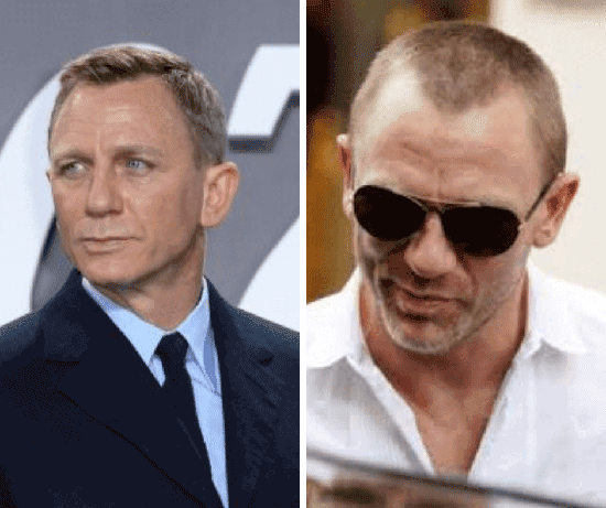 Male Celebrities With Hair Loss | Celeb with Baldness