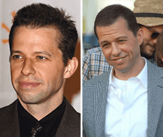 Hollywood celebs with hair loss