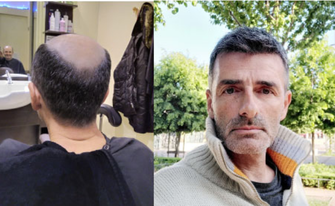 Male Hair Thinning at Crown: Hairfall Causes and Treatments [Updated for  2021]