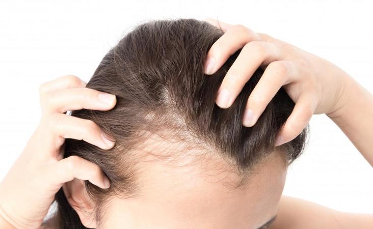 Frontal Fibrosing Alopecia: Causes, Treatments & Success Stories