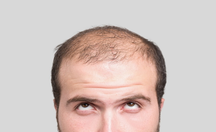 Hair loss characteristics