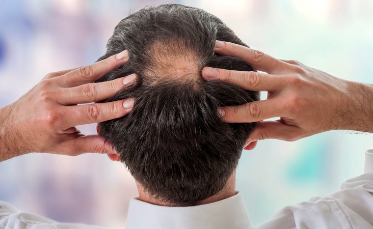 How to get rid of bald spots on head