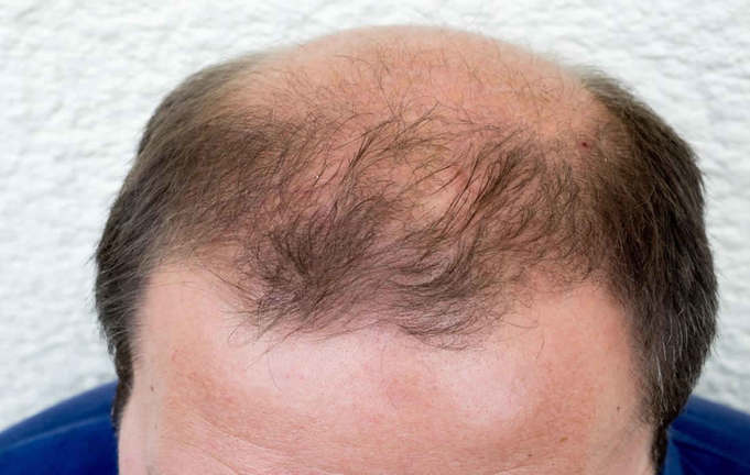 Genetic Hair Loss: Meaning, Causes, Treatments and More