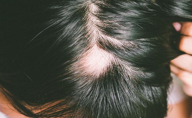 Ursachen von Haarausfall
