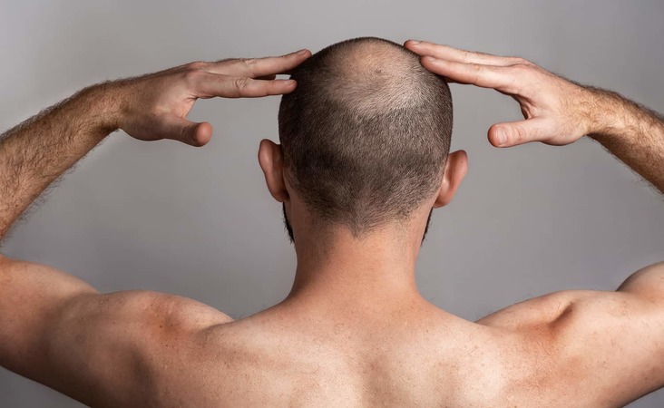 non-scarring alopecia
