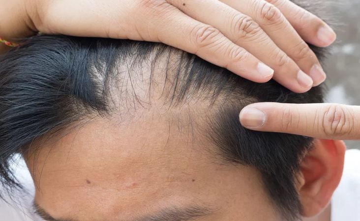 Non-invasive hair loss solution