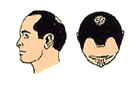 lordhair-partial-hair-loss