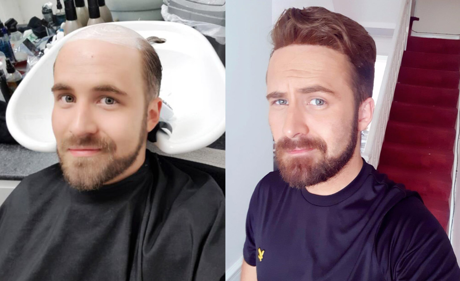 hair system before and after